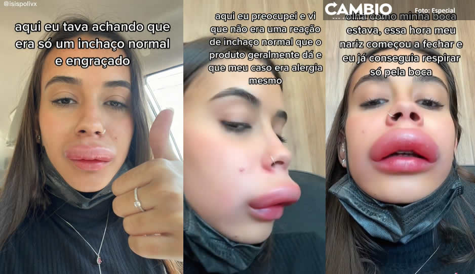 ¡No puede ser! Joven se inyecta los labios y se le deforman (VIDEO)