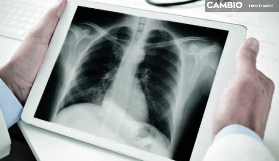 Cáncer de pulmón, el padecimiento con más casos en Puebla: SSA