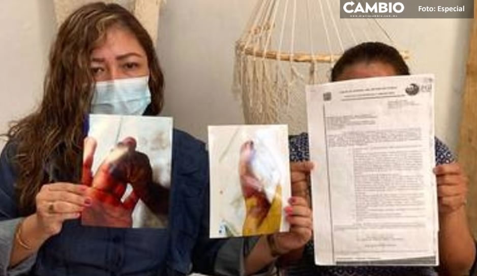 IMAGEN SENSIBLE: Amputan brazo a bebé Matías por negligencia médica en Cacalotepec