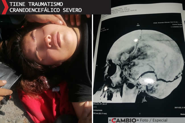 xiclali atropellada 11 sur sigue en coma traumatismo craneoencefalico