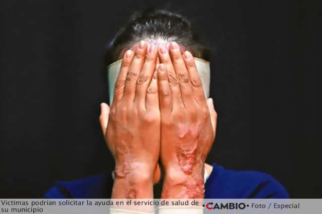 congreso propuesta cirugia reconstructiva gratuita victimas violencia acido