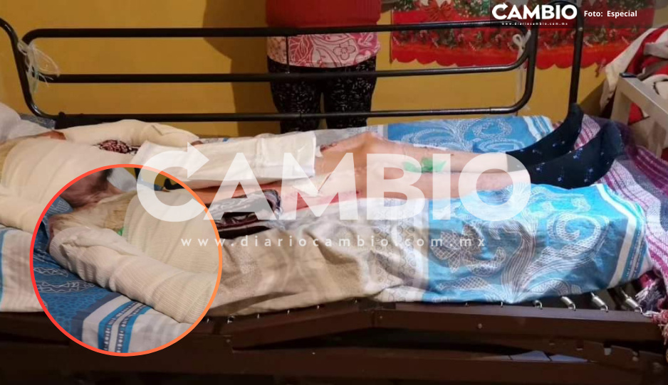 Víctima de polvorín en Xiutetelco pide ayuda para pagar sus curaciones a tres años de la explosión