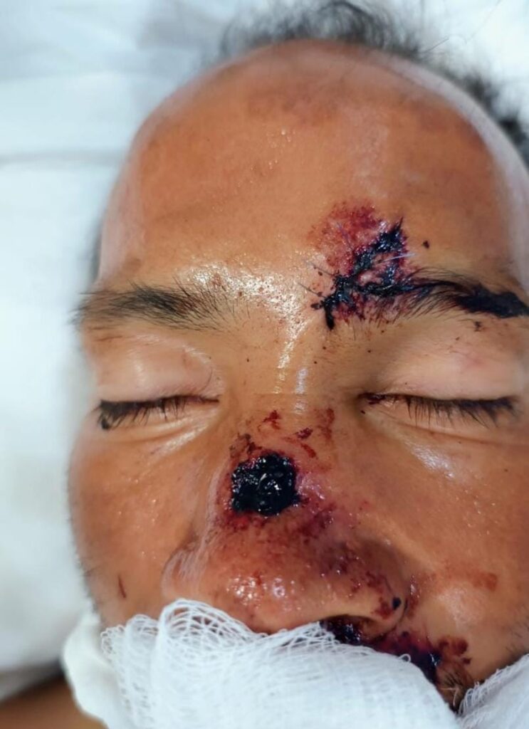 Rigoberto Cruz, ingresado en el hospital de Traumatología y Ortopedia 