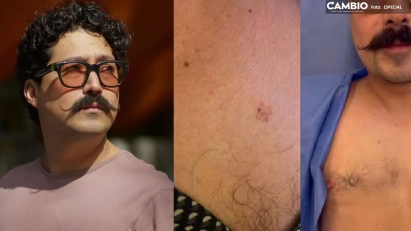 Mau Nieto fue diagnosticado con cáncer de piel (VIDEO)